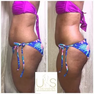 UltraShape Body Contouring & Beauty Services